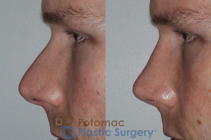 Before & After Rhinoplasty - Cosmetic Case 172 Left Side View in Washington DC & Arlington , DC