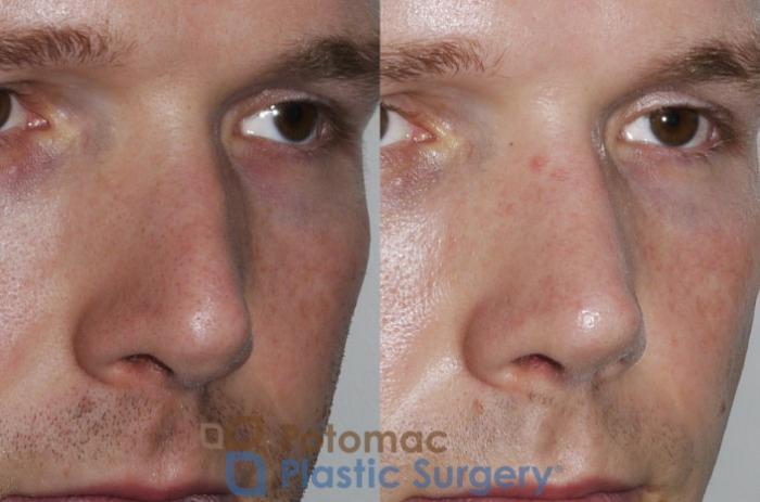 Before & After Rhinoplasty - Medical Case 172 Right Oblique View in Washington DC & Arlington , DC