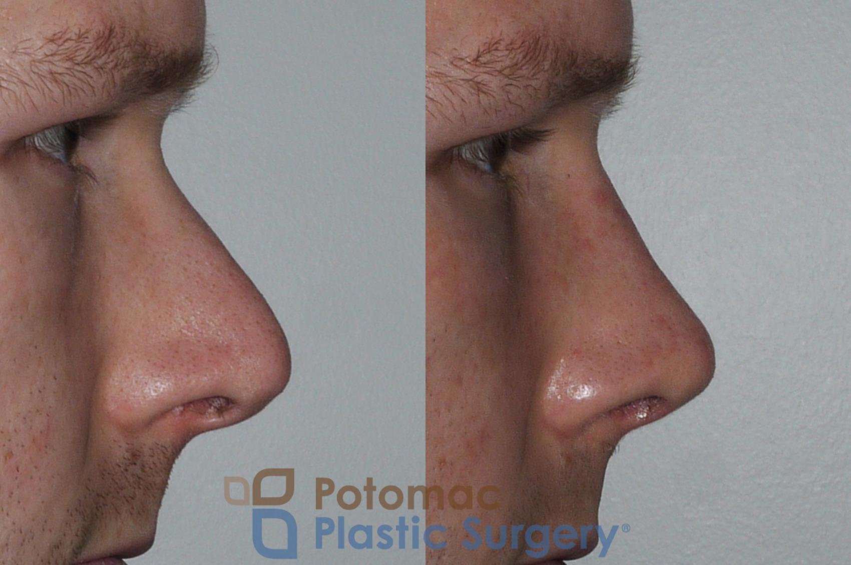 Before & After Rhinoplasty - Cosmetic Case 172 Right Side View in Washington DC & Arlington , DC