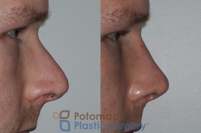 Before & After Rhinoplasty - Medical Case 172 Right Side View in Washington DC & Arlington , DC