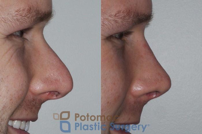 Before & After Rhinoplasty - Medical Case 172 Right Side View #2 View in Washington DC & Arlington , DC