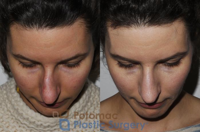 Before & After Rhinoplasty - Medical Case 196 Above View in Washington DC & Arlington , DC