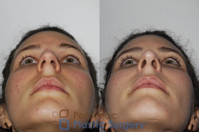 Before & After Rhinoplasty - Cosmetic Case 196 Below View in Washington DC & Arlington , DC