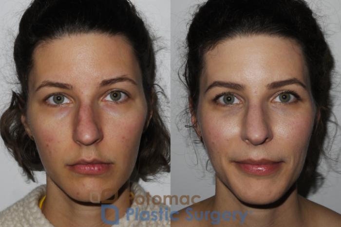 Before & After Rhinoplasty - Medical Case 196 Front View in Washington DC & Arlington , DC