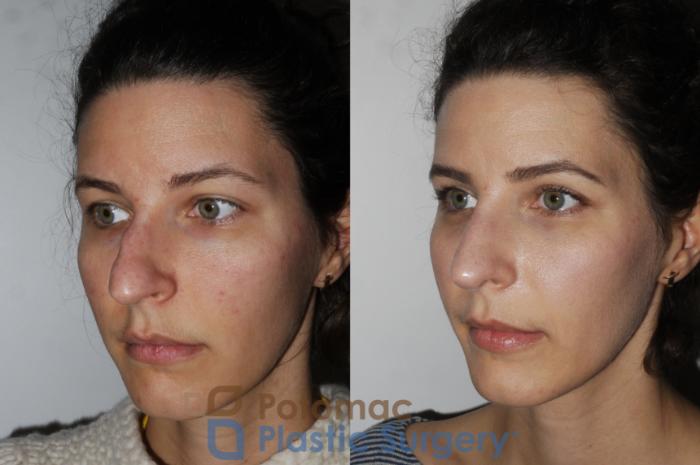 Before & After Rhinoplasty - Cosmetic Case 196 Left Oblique View in Washington DC & Arlington , DC