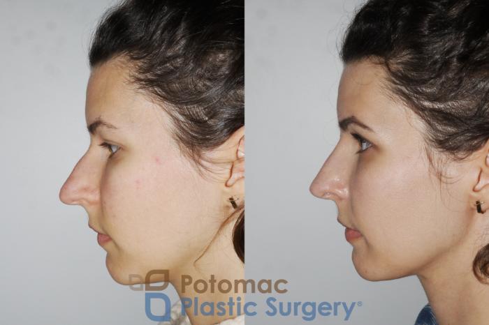 Before & After Rhinoplasty - Cosmetic Case 196 Left Side View in Washington DC & Arlington , DC