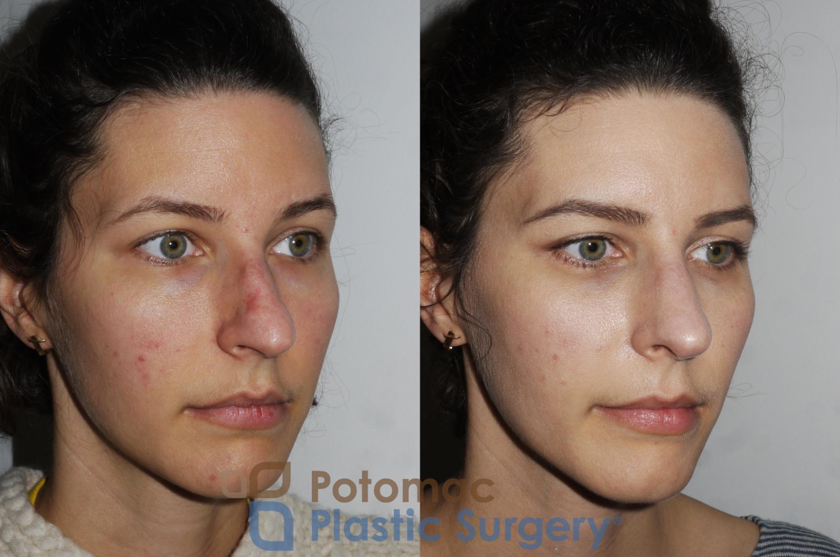 Rhinoplasty - Medical Before & After Photos Patient 196 | Washington Dc 