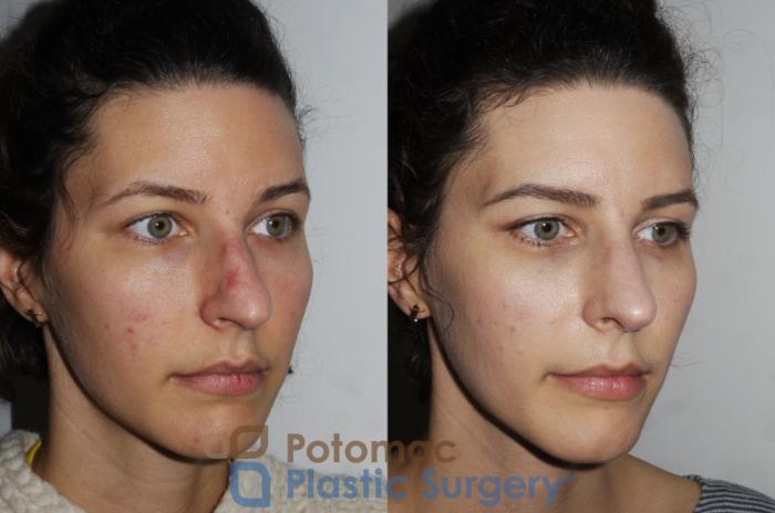 Before & After Rhinoplasty - Cosmetic Case 196 Right Oblique View in Washington DC & Arlington , DC