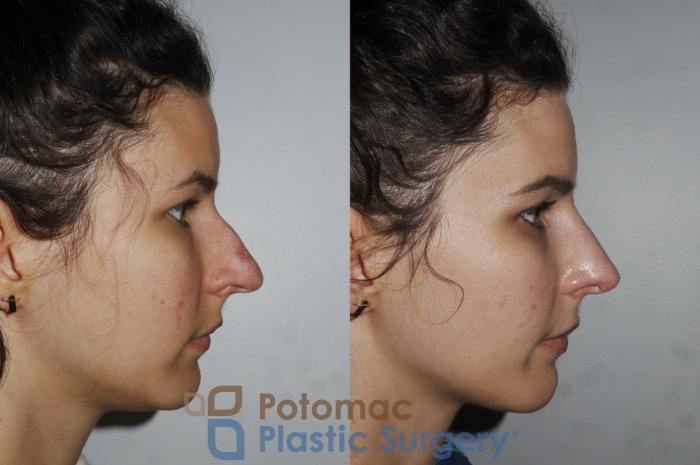 Before & After Rhinoplasty - Cosmetic Case 196 Right Side View in Washington DC & Arlington , DC