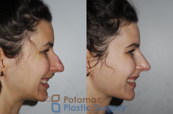 Before & After Rhinoplasty - Medical Case 196 Right Side View #2 View in Washington DC & Arlington , DC