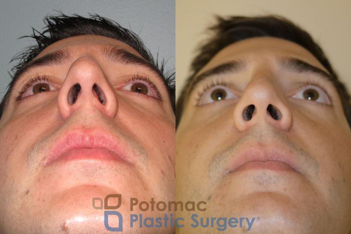 Before & After Rhinoplasty - Cosmetic Case 20 Bottom View in Washington DC & Arlington , DC