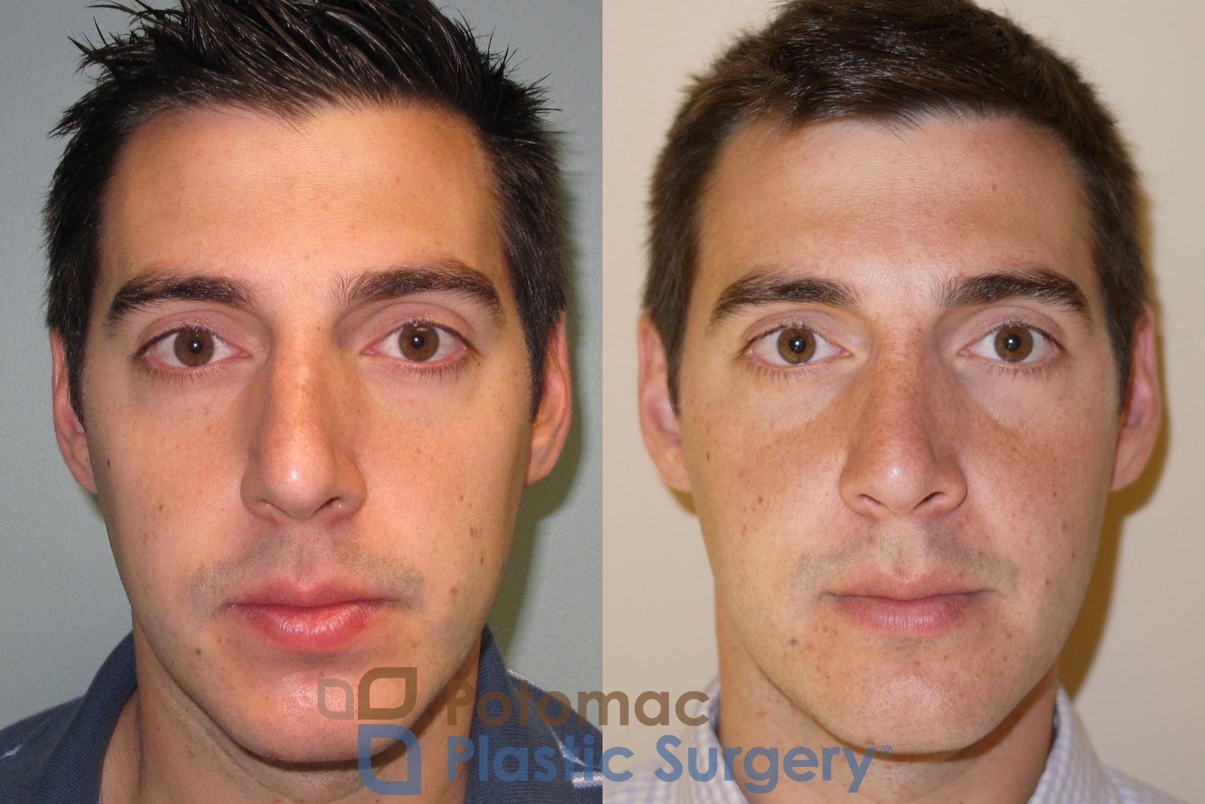Before & After Rhinoplasty - Medical Case 20 Front View in Washington DC & Arlington , DC