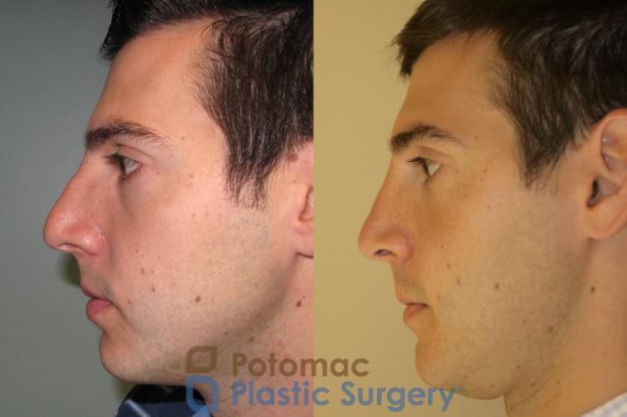 Before & After Rhinoplasty - Medical Case 20 Left Side View in Washington DC & Arlington , DC