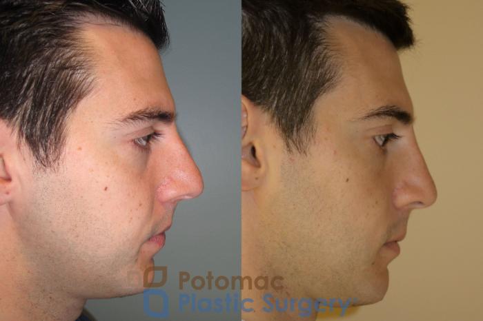 Before & After Rhinoplasty - Medical Case 20 Right Side View in Washington DC & Arlington , DC