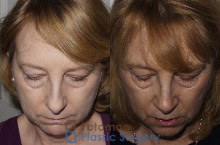 Before & After Rhinoplasty - Medical Case 202 Above View in Washington DC & Arlington , DC