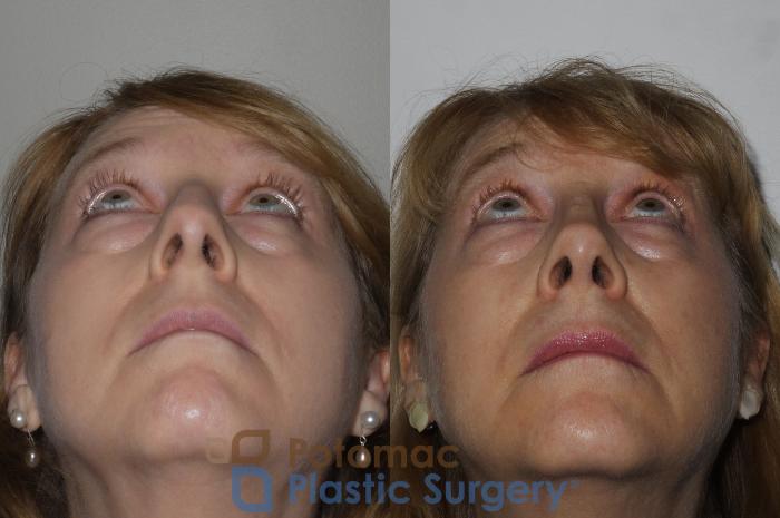 Before & After Rhinoplasty - Cosmetic Case 202 Below View in Washington DC & Arlington , DC