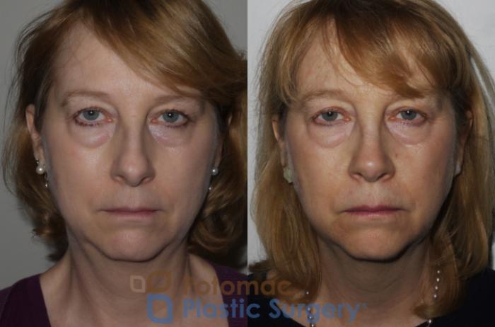 Before & After Rhinoplasty - Medical Case 202 Front View in Washington DC & Arlington , DC