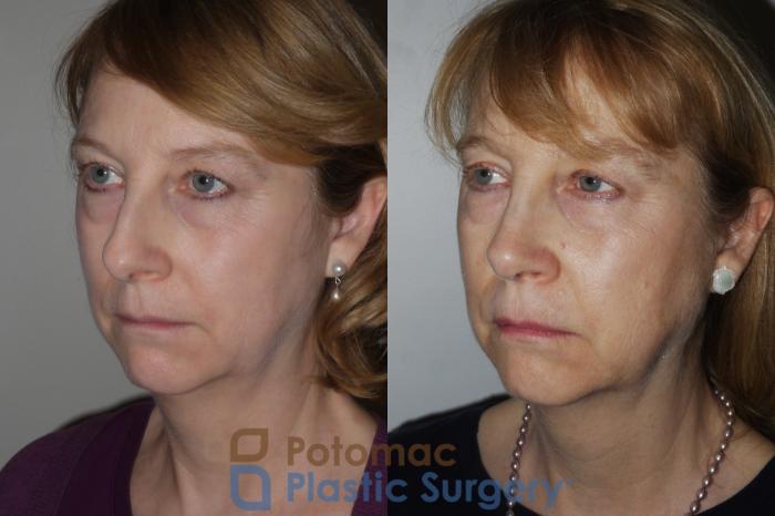 Before & After Rhinoplasty - Medical Case 202 Left Oblique View in Washington DC & Arlington , DC