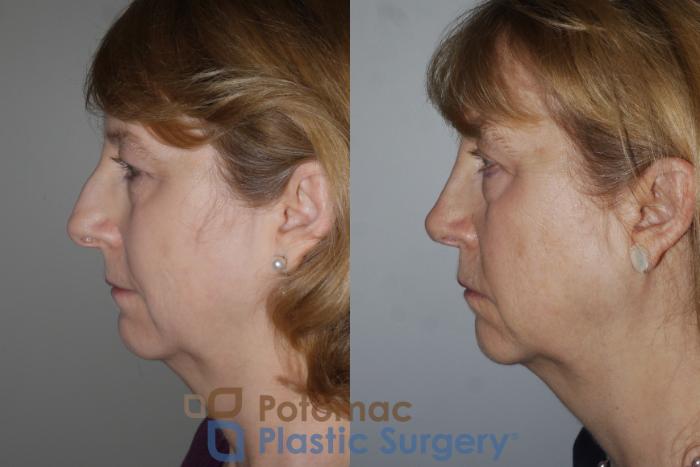 Before & After Rhinoplasty - Cosmetic Case 202 Left Side View in Washington DC & Arlington , DC