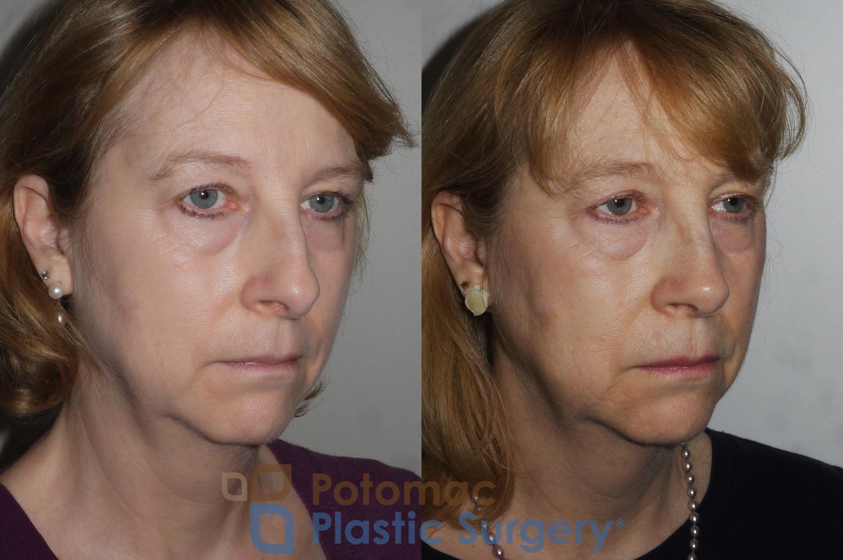 Before & After Rhinoplasty - Cosmetic Case 202 Right Oblique View in Washington, DC