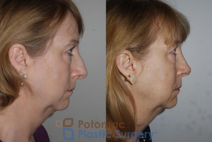 Before & After Rhinoplasty - Cosmetic Case 202 Right Side View in Washington DC & Arlington , DC