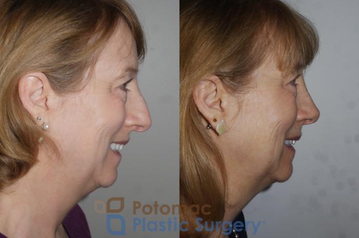 Before & After Rhinoplasty - Medical Case 202 Right Side View #2 View in Washington DC & Arlington , DC
