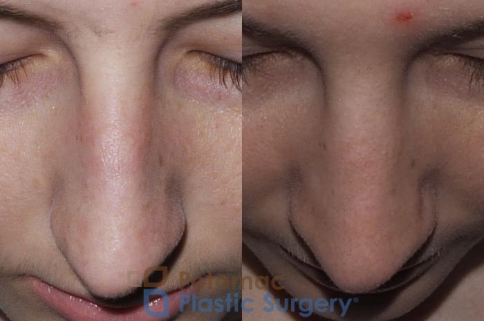Before & After Rhinoplasty - Medical Case 207 Above View in Arlington, VA & Washington, DC