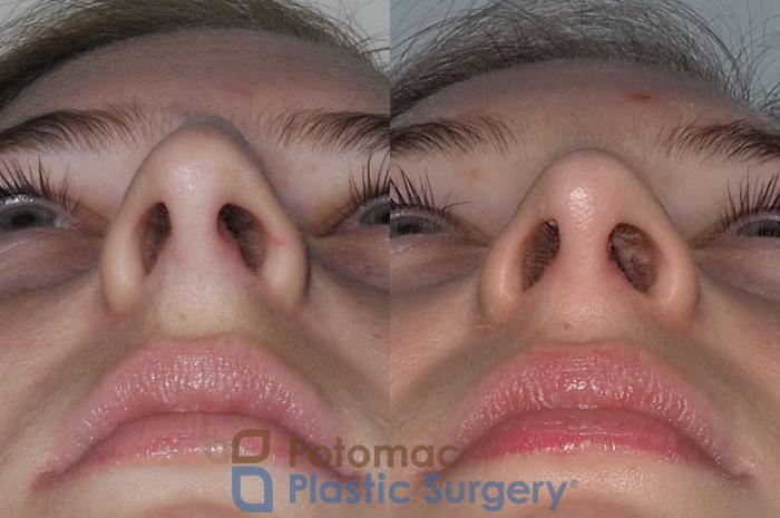 Before & After Rhinoplasty - Cosmetic Case 207 Below View in Arlington, VA & Washington, DC