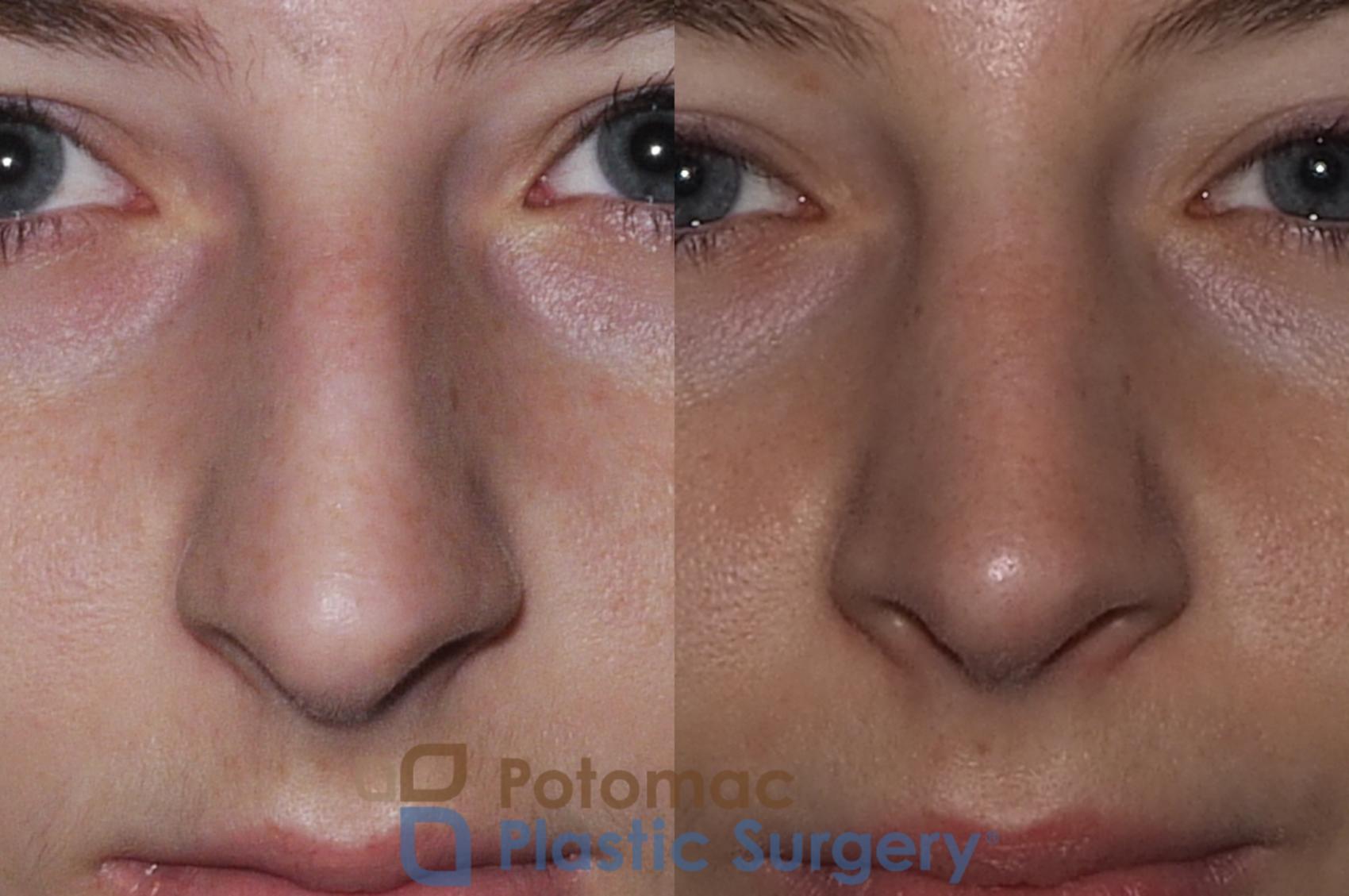Before & After Rhinoplasty - Medical Case 207 Front View in Washington, DC