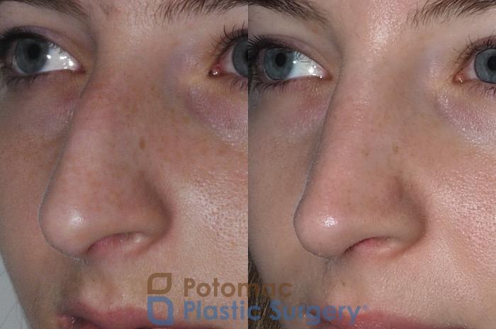 Before & After Rhinoplasty - Medical Case 207 Left Oblique View in Arlington, VA & Washington, DC