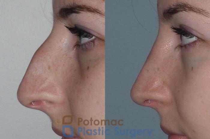 Before & After Rhinoplasty - Cosmetic Case 207 Left Side View in Arlington, VA & Washington, DC