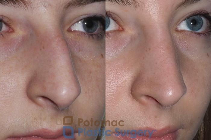 Before & After Rhinoplasty - Medical Case 207 Right Oblique View in Arlington, VA & Washington, DC
