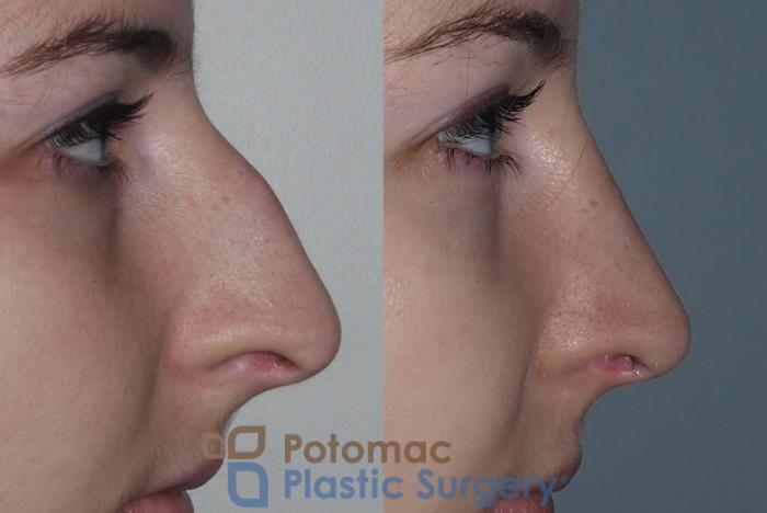 Before & After Rhinoplasty - Cosmetic Case 207 Right Side View in Arlington, VA & Washington, DC