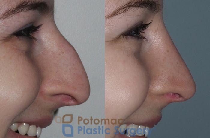 Before & After Rhinoplasty - Medical Case 207 Right Side View #2 View in Arlington, VA & Washington, DC