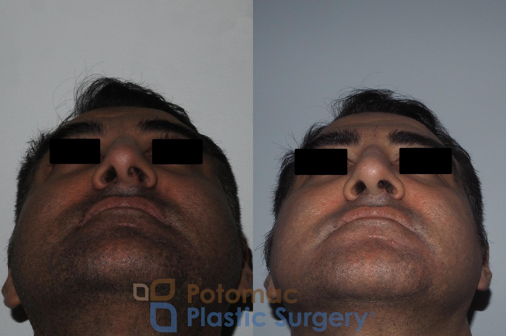 Before & After Rhinoplasty - Medical Case 229 Bottom View in Washington DC & Arlington , DC