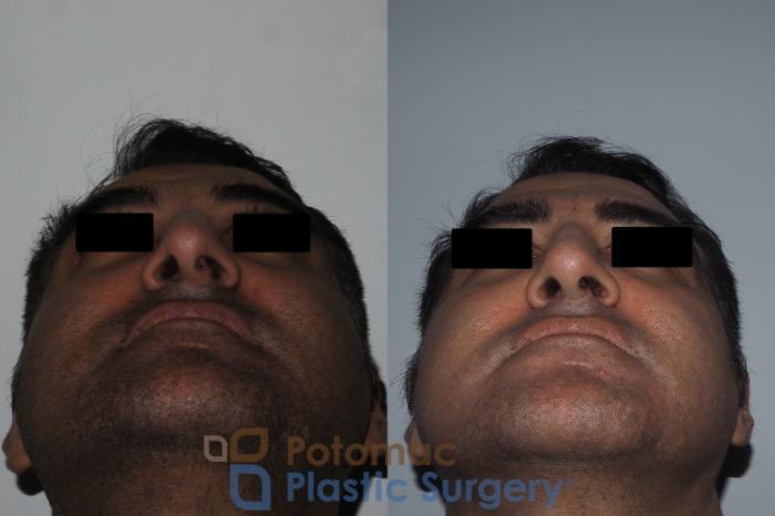 Before & After Rhinoplasty - Medical Case 229 Bottom View in Washington DC & Arlington , DC