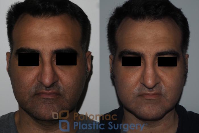 Before & After Rhinoplasty - Cosmetic Case 229 Front View in Washington DC & Arlington , DC