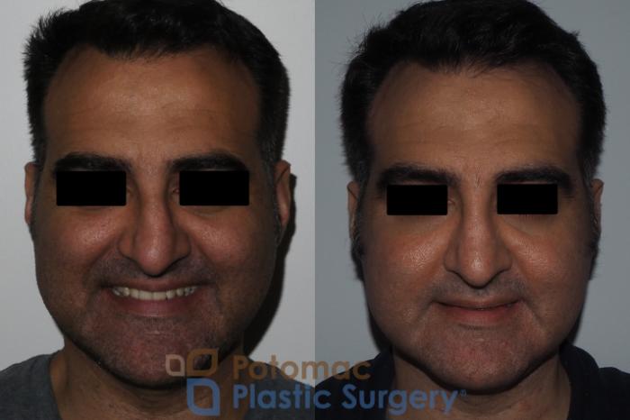 Before & After Rhinoplasty - Cosmetic Case 229 Front View #2 View in Washington DC & Arlington , DC
