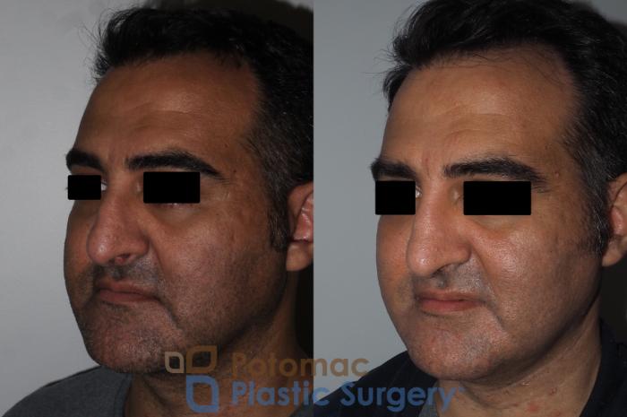 Before & After Rhinoplasty - Medical Case 229 Left Oblique View in Washington DC & Arlington , DC