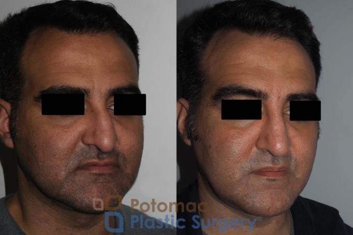 Before & After Rhinoplasty - Cosmetic Case 229 Right Oblique View in Washington DC & Arlington , DC