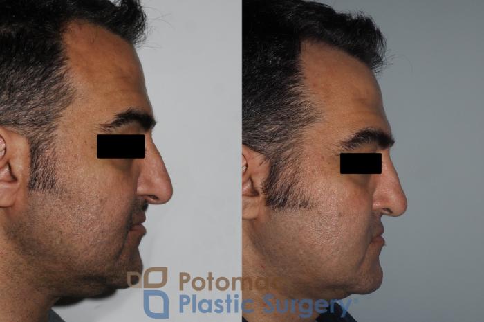 Before & After Rhinoplasty - Cosmetic Case 229 Right Side View in Washington DC & Arlington , DC