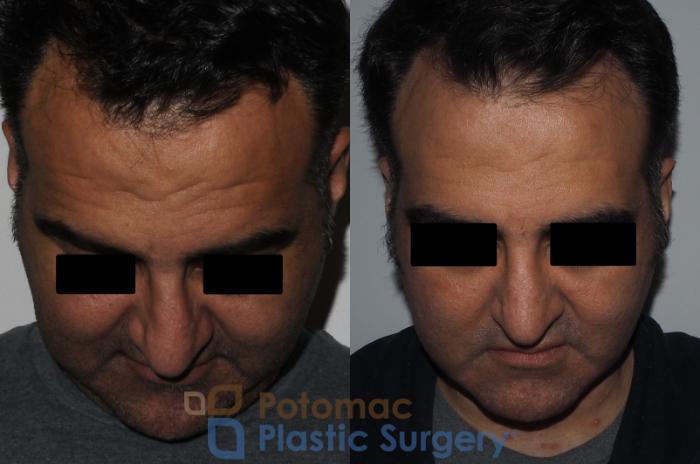 Before & After Rhinoplasty - Cosmetic Case 229 Top View in Washington DC & Arlington , DC