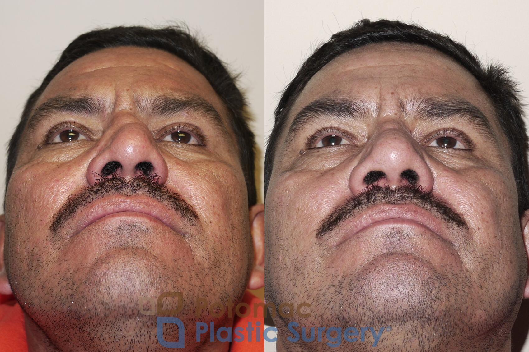 Before & After Rhinoplasty - Medical Case 24 Bottom View in Washington DC & Arlington , DC