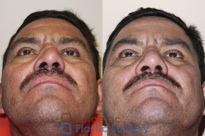Before & After Rhinoplasty - Medical Case 24 Bottom View in Washington, DC