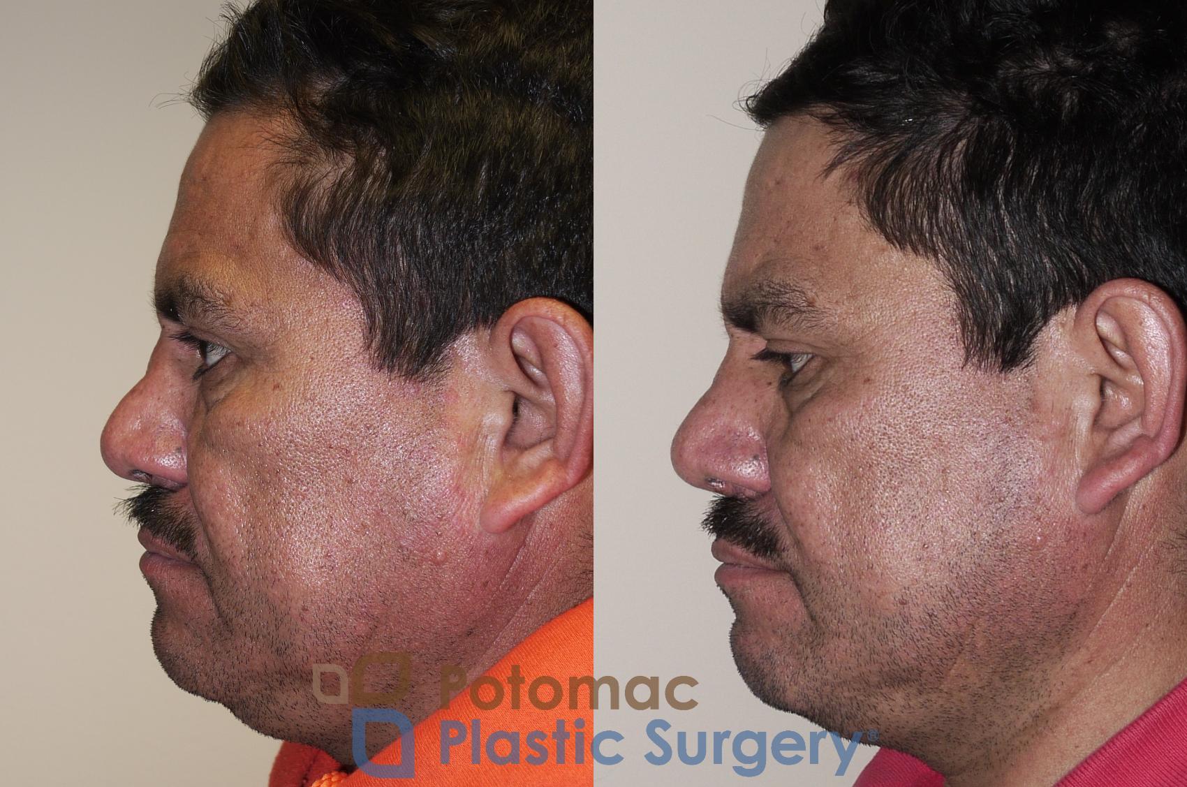 Before & After Rhinoplasty - Medical Case 24 Left Side View in Washington DC & Arlington , DC