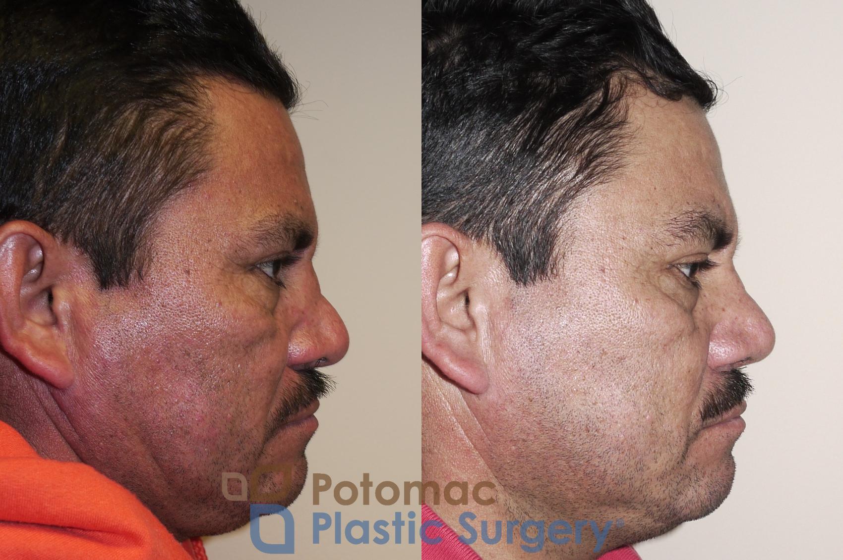 Before & After Rhinoplasty - Medical Case 24 Right Side View in Washington DC & Arlington , DC