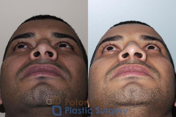 Before & After Rhinoplasty - Medical Case 25 Bottom View in Washington, DC