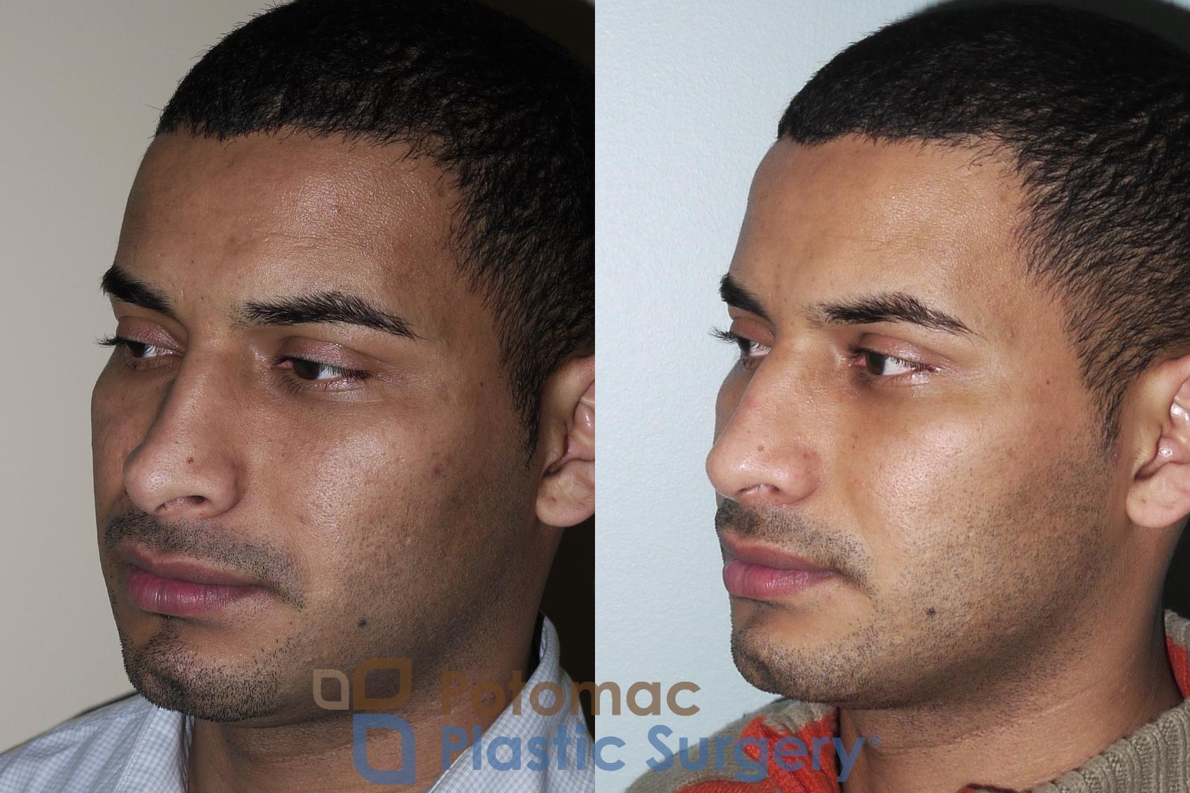 Before & After Rhinoplasty - Medical Case 25 Left Oblique View in Washington DC & Arlington , DC