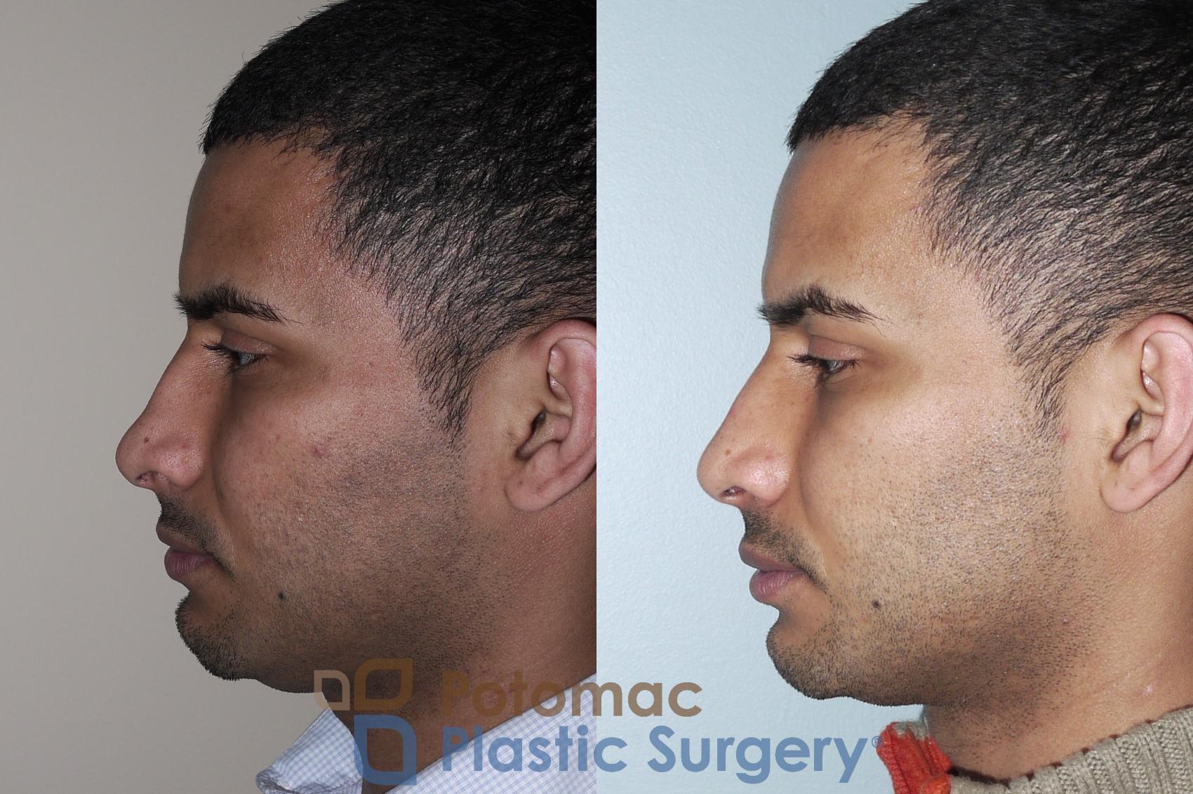 Before & After Rhinoplasty - Medical Case 25 Left Side View in Washington DC & Arlington , DC