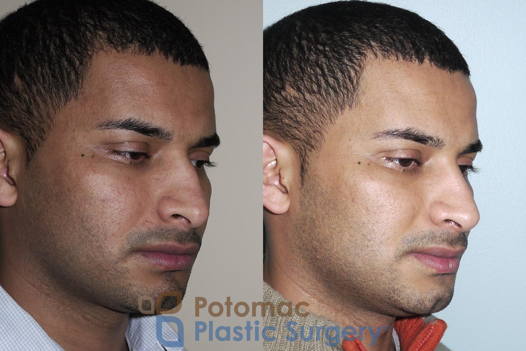 Before & After Rhinoplasty - Medical Case 25 Right Oblique View in Washington DC & Arlington , DC
